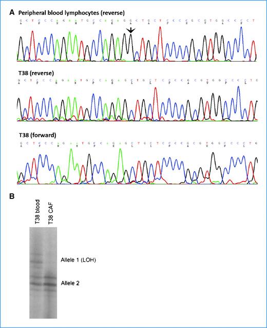 Figure 3. A, TP53 sequencing results from the T38 patient's blood (top) and CAF (bottom). The mutation (arrow), a deletion of a guanine residue in exon 4 at nucleotide position 7520207 (relative to GenBank reference sequence NC_000017), results in the introduction of a stop codon at amino acid position 122. Both reverse and forward sequence results are shown and are consistent. The mutation is not present in lymphocyte DNA from this patient. B, LOH of T38 CAF at D17S786 (near TP53). Amplification and resolution of PCR products using polymorphic microsatellite repeat marker D17S786, which is located ∼1.2 Mb proximal to TP53. Only one of both parental alleles observed in peripheral blood lymphocyte DNA is apparent in T38 CAF derived from the patient-matched sample.
