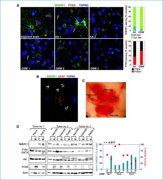 Figure 1. Cytoplasmic NHERF1 expression in GBM tumors. A, tissue microarray confocal microscopy (×400) with the indicated antibodies. NHERF1 localization in perivascular astrocytic processes (arrowheads) and membrane (arrows). Depending on NHERF1 localization, the AA (n = 17) and GBM (n = 37) samples were scored as reactive astrocyte (RA)–like (AA1 and GBM1) and cytoplasmic (Cyt.)–like (AA2 and GBM2). Tumors were considered PTEN-positive (GBM3) if at least two PTEN-positive cells were present in a field. B, confocal microscopy (×600) of normal brain shows NHERF1 membrane localization in astrocytic processes (open arrowheads), including those surrounding brain capillaries (closed arrowheads). C, photograph of a frozen GBM tumor divided into regions containing either necrotic (arrowheads), vascularized, or peripheral tissue. D, Western blot analysis with indicated antibodies of cytoplasmic (C) and membrane (M) fractions prepared from various tumor regions. Tumor no. 1, with unclear regional distinction, was divided into parts A and B. N-cadherin (N-cad) is a membrane fractionation marker. The graph shows the correlation between NHERF1 membrane levels (blue bars) and Akt Ser473 phosphorylation (red squares). r = −0.917, Pearson correlation coefficient for the seven samples with detectable NHERF1 levels. ImageJ program was used for densitometric analysis: NHERF1 cytoplasmic and membrane levels normalized to actin, were summed, and the membrane (Memb.) fraction (%) was calculated from the sum; P-Akt cytoplasmic levels were normalized to total Akt levels (P-Akt/Akt).