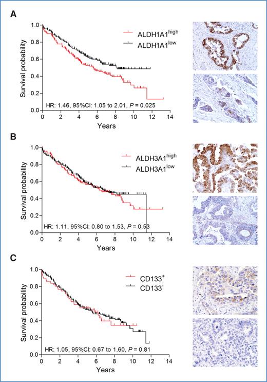 Figure 1. Survival analysis of NSCLC TMA samples expressing ALDH1A1, ALDH3A1 and CD133. A, Kaplan–Meier plot (left) of patient overall survival based on tumors expressing high (red: n = 142) and low (black: n = 140) ALDH1A1 show high ALDH1A1 scores are associated with poor overall survival. B, survival analysis of patients with tumors expressing high (red: n = 141) and low (black: n = 141) ALDH3A1 indicates no association between ALDH3A1 expression and overall patient survival. C, similar analysis of patient samples expressing detectable CD133 (red: n = 56) and no CD133 (black: n = 151) indicates no association between CD133 expression and overall patient survival. Images taken from tumors with high (top) and low (bottom) protein expression are shown to the right of each corresponding survival curve.