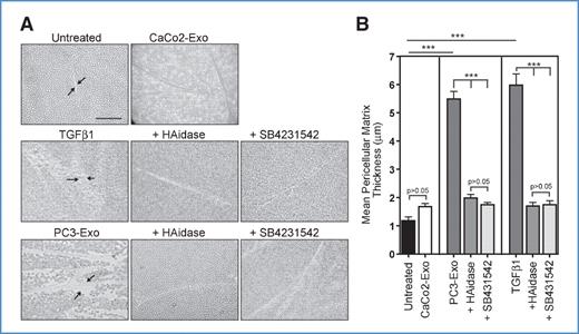 Figure 3. Cancer exosomes trigger deposition of a hyaluronic acid pericellular coat. A, growth-arrested fibroblasts were treated for 72 hours with 200 μg/mL of either CaCo2-derived exosomes (which are TGF-β1low) or with PC3-derived exosomes (TGF-β1high). As a positive control, fibroblasts were stimulated with rhTGF-β1 (5 ng/mL). A type I TGF-β-RI inhibitor (SB431542, at 10 μmol/L) was added to some wells as indicated. After a further 72 hours, hyaluronidase (HAidase) was added (at 200 μg/mL) to some wells as indicated. After washing, formalin-fixed horse erythrocytes were added and allowed to settle (for at least 15 minutes, at 37°C). Scale bar, 100 μm. B, regions of exclusion (examples indicated by arrows) were measured for 20 representative cells for each treatment condition, and the pericellular thickness (calculated as described in Materials and Methods) is shown. Graph represents mean ± SD of pericellular coat thickness (n = 20 cells). ***P < 0.0001, using 1-way ANOVA followed by Tukey's honest significant difference method.