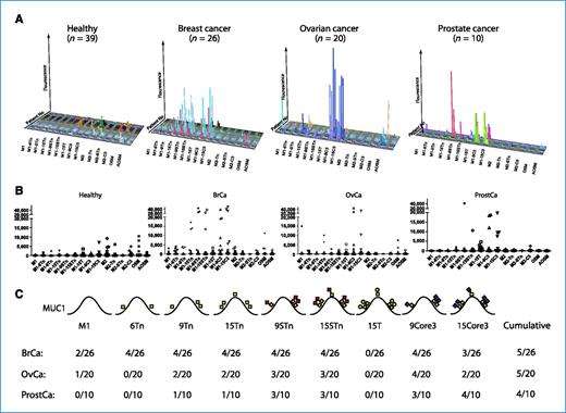 Figure 2. Detection of cancer-induced autoantibodies to MUC1 O-glycopeptide epitopes by microarray analysis. A, three-dimensional column diagram of IgG antibody reactivity in sera from healthy controls (n = 39) and newly diagnosed patients with breast (n = 26), ovarian (n = 20), and prostate (n = 10) cancer (Supplementary Table S1). Specific IgG responses were detected in identified breast, ovarian, and prostate cancer patients toward Tn-MUC1, STn-MUC1, T-MUC1, or truncated core 3 O-glycopeptide epitopes. Only very few healthy subjects and cancer patients had IgG antibodies to AOSM and OSM, which are considered Tn and STn hapten antibodies. B, dot-plot analysis of the antibody responses for each glycopeptide target. C, summary of results for each MUC1 glycopeptide with indication of glycan structures and positions within the MUC1 tandem repeat. Values were considered positive if above three times the SD of the average value obtained with sera from healthy individuals. A total of 5 out of the 26 breast cancer patients showed induction of IgG autoantibodies to either Tn, STn, T, or core 3 MUC1 glycopeptides. The same reactivity pattern was seen in ovarian cancer patients with 5 out of 20 patients, demonstrating IgG autoantibodies to one or more of the MUC1 glycopeptides. In contrast, 4 out of 10 prostate cancer patients showed induction of autoantibodies to STn, T, and core 3 MUC1 glycopeptides. In the majority of individuals, no reactivity was seen with Tn and STn MUC2 glycopeptides or AOSM and OSM.