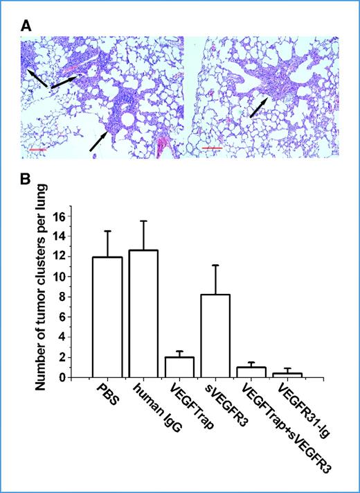 Figure 5. VEGFR31-Ig potently inhibits HCCLM3 tumor lung metastasis in mice. HCCLM3 cells (1 × 106 per mouse) were inoculated s.c. into the right flank of male SCID mice. One day after inoculation, the mice were treated with 25 mg/kg of VEGFTrap, sVEGFR3, VEGFR31-Ig, or VEGFTrap plus sVEGFR3 twice weekly. After 6 wk, animals were euthanized and lungs were collected. Sections of the lungs were stained with H&E, and lung metastatic foci were counted. A, representative lung tissue sections from PBS (left) and VEGFR31-Ig (right) treatment groups (magnification, ×200). Arrows indicate metastatic foci. Scale bars, 200 μm. B, the average number of lung metastatic foci for each group. Columns, mean; bars, SD.