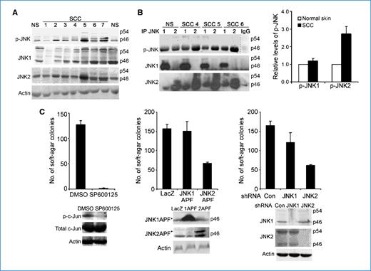 Figure 1. JNK2 activation is increased in human SCC and is required for tumorigenesis of A431 SCC cells. A, immunoblotting for p-JNK, JNK1, and JNK2 with protein lysates from normal human skin (NS) and SCC samples. JNK1, JNK2, and p-JNK displayed varying intensities at 46- and 54-kDa MW positions among different tissue samples, but the 46-kDa bands were stronger than the 54-kDa bands in most samples. B, immunoprecipitation with antibodies against JNK1, JNK2, or GM-CSF for IgG control followed by immunoblotting for p-JNK, JNK1, and JNK2. Representative images for normal human skin and three SCCs are shown and additional samples are presented in Supplementary Fig. S1. Columns, average relative optical densitometry of the p-JNK band from nine SCC samples examined; bars, SD. C, A431 soft-agar colony formation in response to JNK inhibition by 10 mmol/L SP600125, expression of JNK1(APF) or JNK2(APF), or shRNA-mediated gene silencing of JNK1 or JNK2. Columns, average numbers of colonies from triplicate experiments; bars, SD. JNK kinase inhibition, expression of the JNK mutants, and targeted gene silencing were confirmed by immunoblotting for p-c-Jun, total c-Jun, JNK1, or JNK2 with actin for loading control, as shown below each graph.