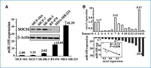 Figure 2. Expression of socs1 and mir-155 in breast cancer cells and primary breast tumors. A, expression of mir-155 and socs1 in breast cancer cell lines. Top, Western blot analysis of SOCS1 protein levels; bottom, qRT-PCR analysis of miR-155 levels. B, qRT-PCR analysis of miR-155 and SOCS1 mRNA levels in primary breast tumors. The inset graph indicated a statistically significant inverse correlation (R = −0.73, P = 0.038) in 9 of 15 tumors. The normalized references were the same as that in Fig. 1.