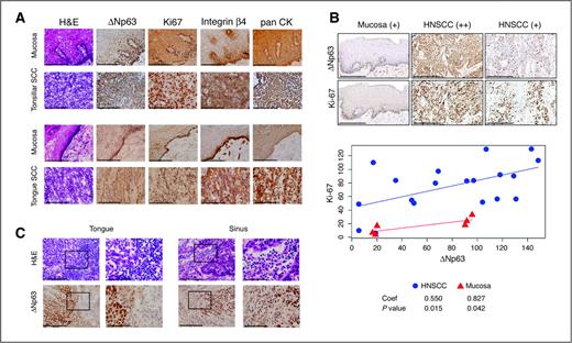 Figure 6. Diffuse ΔNp63, Ki-67, and β4 integrin staining with inflammation in HNSCC compared with basilar staining pattern and lack of inflammation in mucosa. A, frozen sections of tonsillar and tongue SCC with matched mucosa were stained with hematoxylin and eosin (H&E), and ΔNp63, Ki-67, β4 integrin, and pan-CK antibodies by immunoperoxidase (×400; scale bar, 200 μm). B, tissue array of HNSCC was immunostained and quantified using histoscore system (×200; scale bar, 200 μm). Linear regression and Pearson correlation for ΔNp63 and Ki-67. Coefficient of the slope and statistical significance are shown. C, ΔNp63 staining in a tongue and sinus HNSCC, with adjacent infiltrating inflammatory cells. Left, ×400; scale bar, 200 μm. The black rectangle frames highlight the areas shown at ×1,000 in right panels; scale bar, 80 μm.