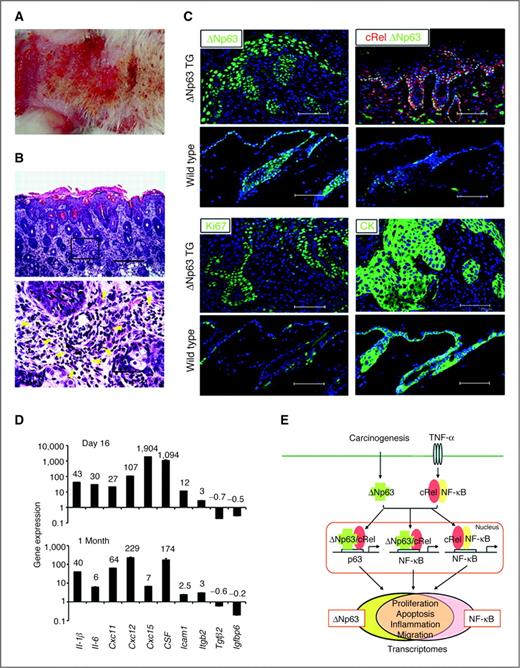 Figure 7. Skin from ΔNp63α TG mice shows hyperplasia, cellular inflammation, and increased proinflammatory cytokine expression. ΔNp63α was induced in skin of TG animals for 2 months after birth. A, gross morphology, erythematous lesions. B, histology, hematoxylin and eosin stain. Top, epidermal hyperplasia and cellular inflammation in dorsal skin sections (×100; scale bar, 300 μm). Bottom, infiltrating inflammatory cells in the dermis highlighted by yellow arrowheads (×600; scale bar, 50 μm). C, dorsal skin sections from ΔNp63α TG and wild-type mice were stained with anti-ΔNp63, cRel, Ki-67, and K14 (CK) antibodies and DAPI counterstain (scale bar, 75 μm). D, gene expression in dorsal skin 16 days (top) or 1 month (bottom) following ΔNp63α induction in neonatal TG mice, versus wild-type littermates. E, model of ΔNp63 and NF-κB/Rel interactions mediating regulation of a broad gene program. Overexpressed ΔNp63 following carcinogenesis and cRel or RelA, activated by TNF-α from inflammation in the tumor microenvironment, interact via p63 or NF-κB sequences of target gene promoters. p63/Rel protein complexes regulate a broad gene program that overlaps with NF-κB transcriptome and promotes the malignant phenotype.