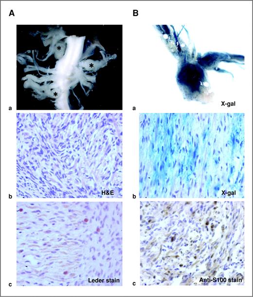 Figure 3. NF1 inactivation during the SCP stage leads to plexiform neurofibroma formation. A, an example of 3 macroscopic plexiform neurofibromas from spinal roots (a, *). H&E staining of the tumor shows features consistent with plexiform neurofibroma, including disordered, convoluted bundles of cells exhibiting spindle-cell morphology with ovoid and spindle-shaped nuclei, and adjacent fine fibrillar stroma (b). There is also massive mast cell infiltration within the tumor, as shown by Leder staining, which stains mast cells red (c; original magnification 20×). B, neurofibromas were also harvested for gross X-gal staining of whole tumor (a). Tumor tissues were then postfixed in formalin for paraffin sectioning. The corresponding paraffin sections also show histologic evidence of neurofibroma with X-gal–positive staining (b), disordered spindle-cell morphology, ovoid and spindle-shaped nuclei, and immunohistochemical stain shows spindle cells within neurofibroma are positive for S100 (c; original magnification 20×).