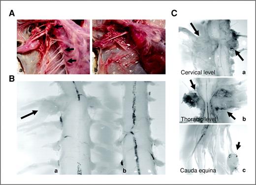 Figure 4. NF1 inactivation during the immature Schwann cell stage leads to plexiform neurofibroma formation. A, peripheral nerve enlargement, specifically in the brachial plexus and thoracic nerves (arrows) in sick PLPCre-ERT2;NF1flox/− mice (a) compared with control littermates (b). B, plexiform neurofibromas developed in close proximity to the DRG (arrow) in every sick PLPCre-ERT2;NF1flox/− mouse (a) but none were observed in control littermates (b). C, these plexiform neurofibromas (arrows) developed exclusively near the spinal roots/DRG at the cervical (a) and thoracic (b) level. They are sometimes also seen in the cauda equina (c).