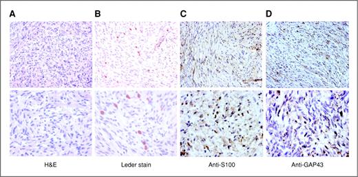 Figure 5. Histologic and immunohistologic analysis of the genetic engineered mouse-neurofibromas. The mutant PLPCre-ERT2;NF1flox/− mice robustly developed paraspinal tumors near the DRG when NF1 is ablated at the immature Schwann cell stage. A, representative H&E staining of these tumors showing classic features of plexiform neurofibroma (original magnification: 10× in the top and 40× in the bottom). B, Leder staining shows heavy infiltration of mast cells (red) within the plexiform neurofibroma (original magnification: 10× in the top and 40× in the bottom). C, anti-S100β and (D) anti-GAP43 immunohistochemistry shows that spindle cells in the plexiform neurofibroma are positive for the Schwann cell markers S100β and GAP43 (original magnification: 10× in the top and 40× in the bottom).
