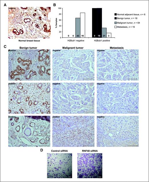 Figure 6. H2Bub1 expression in human normal breast tissue, tumors, and metastasis. A, representative immunohistochemical image displaying H2Bub1 protein expression in normal breast tissue; bar = 100 μm. B, bar graph representing the immunohistochemical analysis of the H2Bub1 staining in normal adjacent tissue, the indicated breast tumors, or metastasis. Shown are relative numbers in “% samples” as well as the absolute numbers of samples on the bottom of each bar. C, representative sample pictures of a tissue microarray analysis showing immunohistochemical H2Bub1 staining in benign, malignant, and metastatic breast tumor samples. Samples were categorized into 2 groups as either negative or positive for H2Bub1 (shown in left top corners of the images); bar = 100 μm. D, cell migration assay after RNF40 knockdown. Control or RNF40 depleted MCF10A cells were seeded onto cell culture inserts and allowed to migrate for 48 hours. Representative images from an experiment are shown, bar = 500 μm.