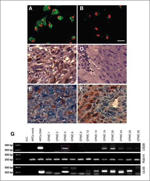 Figure 1. HCMV US28 transcript and protein are expressed in human GBMs. A and B, primary GBM-derived cultures were processed for US28 immunofluorescence in the absence (A) or presence (B) of a blocking peptide. Nuclei are counterstained with propidium iodide. Bar, 100 μm. C–F, consecutive (5 μm) paraffin sections obtained from a different GBM patient sample were processed for US28 (C and D), VEGF (E), and COX2 (F) immunohistochemistry. Counterstaining, hematoxylin. Bar, 100 μm. G, reverse transcriptase PCR for US28 was done using cDNA from several GBM cases. HCMV-infected neural precursor cells (NPC + CMV) served as positive controls. Several cases show a US28 band of the correct size. HCMV UL56 detection is also shown. Rab14 was used to verify equal loading. NC, negative control.