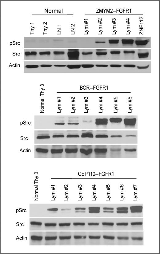 Figure 3. Src is activated in primary lymphomas. Western blot analyses of phosphoactivated and total Src levels in normal thymocytes (Thy) and normal lymph nodes (LN) from normal Balb/c mice compared with cells derived from lymphoma in lymph nodes (Lym) from mice with leukemia/lymphoma from the 3 different fusion kinase models. In these experiments, Src activation is seen in the majority of primary tumors from the 3 different models.