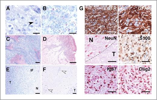 Figure 2. Representative histologic photomicrographs of TGFα–EGFRWT; InkΔ2/3−/− tumors. Hematoxylin and eosin–stained paraffin-embedded tumor sections. A, tumors are set on a fibrillary background and contain densely packed cells featuring pleomorphic nuclei with prominent nucleoli and mitoses (black arrowhead). B, giant multinucleated cells are present within tumors. C, tumors exhibit marked pseudopallisading necrosis. D–F, the highly infiltrative nature of TGFα–EGFRWT tumor cells is depicted, (D) tumor cells migrate within meninges in the subarachnoid space and invade the Virchow–Robin space and (E) are infiltrating normal parenchyma (N) by forming a loose infiltrating front (IF) away from the bulk tumor (T) and (F) tumor cells migrate along blood vessels and invade the perivascular space (white arrow head) distant from the bulk tumor (T). G, EGFRWT GBM tumors express markers of astrocytic differentiation. Representative photomicrographs of tumors stained with cell lineage markers using immunohistochemistry. Tumors stain positive for markers of astrocytic lineage [glial fibrillary acidic protein (GFAP) and S100] and negative for markers of neuronal (NeuN) lineage. GBM tumors also stain positive for human EGFR, the proliferation marker Ki67, and for Olig2. EGFR, GFAP, and S100 sections were counterstained with hematoxylin and sections for the nuclear NeuN, Olig2, and Ki67 markers were counterstained with eosin. N, normal brain; T, tumor. Scale bars, 25 μm (A), 50 μm (B, F, G), 62.5 μm (D), and 125 μm (C, E).
