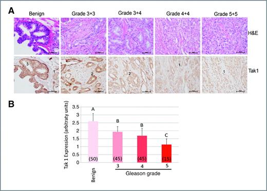 Figure 1. Expression of Tak1 is lost in high-grade human prostate cancer. A, H&E and immunohistochemistry for Tak1 in representative prostate specimens. The numbers within images are the deduced expression score based on the expression matrix depicted in Supplementary Fig. S1 for Tak1 expression. The benign section contains a small focus of carcinoma with reduced expression of Tak1 relative to the benign tissue in the same section. B, the expression intensity of Tak1 was scored in each section based on the matrix presented in Supplementary Fig. S1 and categorized based on tissue pathology. Each bar represents the mean ± SEM. Numbers in parentheses represent the sample size for that specific pathology that was scored. Bars with the same letter above them are not statistically significantly different from each other. Statistical significance was determined by ANOVA with post hoc analysis by Sheffe multiple comparison test, P < 0.05 was considered significant.