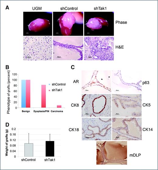 Figure 4. Suppression of Tak1 promotes invasive carcinoma in vivo. A, histology of representative grafts generated by recombination of UGM with shControl or shTak1 cells. Top panels: Representative gross morphology after 10 weeks in vivo. Bottom panels: Representative sections stained with H&E. Scale bars: ×10, 2,000 μm; ×400, 50 μm. B, distribution of phenotypes in shControl and shTak1 tissue recombinant grafts. H&E-stained sections from each graft were scored for the presence of benign, PIN, and carcinomatous structures by 2 observers who were blinded to the genotype of the graft. Each column represents pooled data for shControl clones and for shTak1 clones. C, complete lineage differentiation of shControl cells in vivo. Immunohistochemistry of AR, CK8, CK18, p63, CK5, CK14, and mouse dorsal-lateral secretory protein (mDLP) showing complete lineage differentiation of shControl cells in vivo. D, quantification of average weight of grafts formed by shControl or shTak1 cells. Bars represent the mean ± SEM.