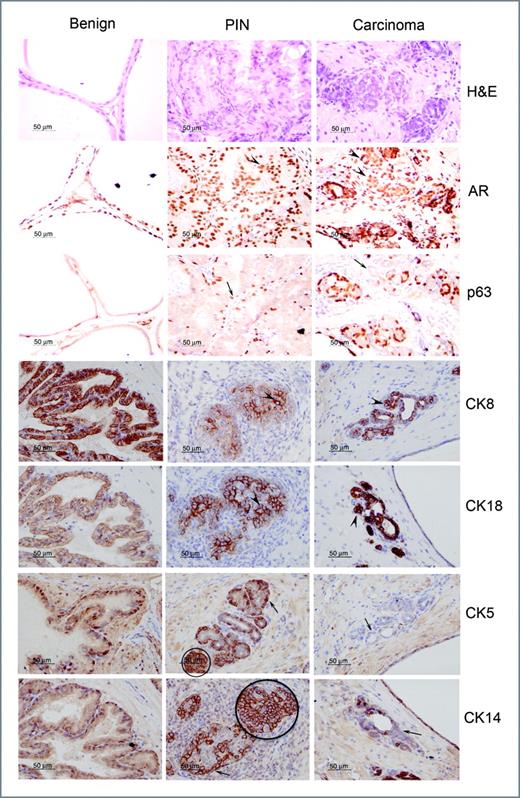 Figure 5. Suppression of Tak1 in PrP/SCs leads to heterogeneous phenotypes including benign prostate, PIN, and carcinoma in vivo. Immunohistochemistry for AR, p63, CK8, CK18, CK5, or CK14 of representative areas of benign prostate, PIN, and carcinoma from shTak1 grafts. PIN areas show retention of intact basal layer (arrow), pleiomorphic nuclei, prominent nucleoli, and hyperplastic filling of lumen (arrow head). Carcinoma areas show lacking of intact p63, Ck5, or CK14 positive basal layer (arrow) and elevated AR, CK8, or CK18 expression (arrow head). All images were taken at ×400 magnification. Scale bar, 50 μm.