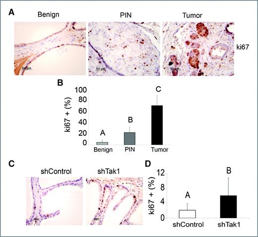Figure 7. Suppression of Tak1 increases cell proliferation in vivo. A, immunohistochemistry for Ki67 of representative areas of benign prostate, PIN, and carcinoma from shTak1 grafts. B, quantification of Ki67+ cells in representative areas of benign prostate, PIN, and carcinoma from grafts containing shTak1 cells. Bar chart shows the significant increase of percentage of ki67-positive cells in PIN and tumor areas. Expression of Ki67 was quantified with percentage of ki67-positive cells to the total cells in each area (n = 10). Results are mean ± SEM. A, B, and C are significantly different; P < 0.05, 2-sided. Nonparametric analysis was used. C, immunohistochemistry for Ki67 in benign areas from shControl or shTak1 recombinants. D, quantification of ki67+ cells from C. Quantificational methods and statistics were described in B.