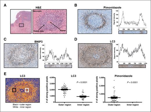 Figure 6. Histologic analysis of in vivo LC3 expression in MDA-MB-231 MFP tumors. A, H&E staining of a representative region from an MDA-MB-231 tumor cross-section. A ×20 magnification shows a single vessel encapsulated by viable cells (dark purple) surrounded further by necrotic tissue (pink). The same vascular region from sequential cross-sections was used for immunohistochemical analysis. B–D, pimonidazole hydrochloride was injected 1 hour before tumor removal to detect hypoxic tissue. Additional staining shows similar spatial expression patterns for BNIP-3 (C) and LC3 (D) to pimonidazole hydrochloride. E, positive pixel analysis of LC3 and pimonidazole hydrochloride in the outer region (black region) and inner region (white region) of a vascular cross-section using Aperio Positive Pixel Count v9 (blue, negative; yellow, weak positive; orange, positive; red, strong positive). Each region of interest is of the same size containing the same number of pixels. The number of strong positive pixels in the outer and inner region of 5 separate vascular cross-sections is plotted for LC3 and pimonidazole hydrochloride.