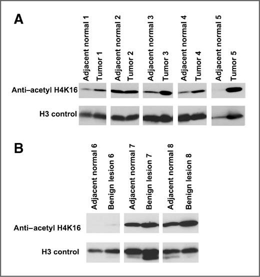 Figure 5. Western blot analysis of H4K16 acetylation in lung tissue. A, 5 paired tumor and adjacent normal lung tissues. Four samples showed increased H4K16 acetylation B, three paired benign nodules and adjacent normal lung tissue. The paired samples have similar levels of H4K16 acetylation.