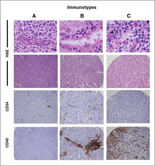 Figure 1. Immunotypes. TMAs are stained with routine H&E (400× and 100×), immunostained with CD34 and CD45, and scored for immune cell density and location for immunotyping. Metastatic melanomas are characterized as “Immunotype A” when immune cell infiltrate is absent, “Immunotype B” when immune cell infiltrate is perivascular only, and “Immunotype C” when immune cells are infiltrating among tumor cells beyond the vessels.