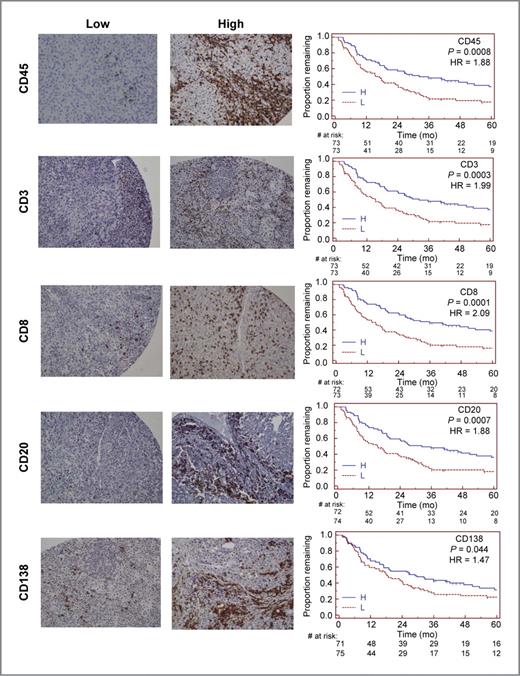 Figure 4. Patient survival and associations with immune cell density. Representative examples of sections with low- or high- numbers of cells staining for CD45, CD3, CD8, CD20, and CD138 are shown beside Kaplan–Meier survival curves for low and high counts of those markers. Magnification, 200×.