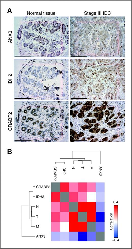 Figure 5. Validation of MS data using immunohistochemistry on tumor arrays. Breast cancer tissue arrays were reacted with anti-ANX3, anti-IDH2, or anti-CRABP2 antibodies. A, representative healthy and stage III invasive ductal carcinoma (IDC) tumor tissues are shown. (scale bar = 150 μm). B, the staining intensity of each tissue was scored and the compared with the tumor, lymph node, and metastatic state of the tumors. Heatmap shows the correlation between the staining scores and the clinical information.
