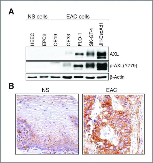 Figure 1. AXL is overexpressed in esophageal adenocarcinomas. A, protein extracts from normal esophageal squamous epithelial cell lines (NS) and esophageal adenocarcinoma cell lines (EAC) were subjected to Western blot analysis of AXL and p-AXL(Y779) proteins. B, a representative AXL IHC staining of normal esophageal squamous epithelial tissue sample (NS; left), showing a weak membrane staining (brown color) predominantly in the lower third of the mucosa. A representative AXL IHC staining of a moderately differentiated esophageal adenocarcinoma tissue sample (EAC; right) indicating a strong cytoplasmic and membrane staining.