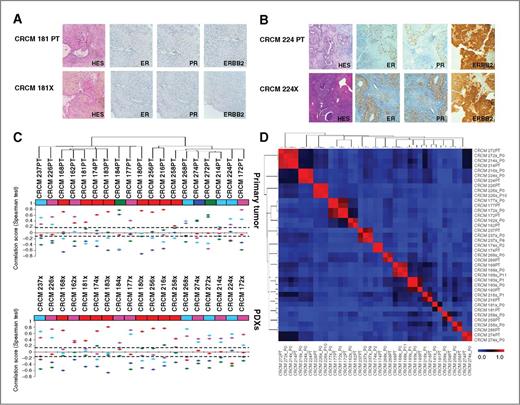 Figure 1. PDXs resemble the primary tumors from which they are derived. A and B, histology of two paired primary tumors/PDXs: CRCM181, a triple-negative metaplastic breast cancer (A), and CRCM224, a luminal B breast cancer (B). Histology evaluated after hematoxylin and eosin staining and immunohistochemical staining for ER, PR, and ERBB2 protein expression are strictly conserved in PDXs. C, correlation of gene expression of the 19 paired primary tumors (top)/PDXs (bottom) to 5 molecular subtypes defined by the PAM50 predictor. For each subtype, a median profile is defined and compared with the sample's median profile. Correlation coefficients are plotted by colors indicating the subtype: dark blue, luminal A; light blue, luminal B; red, basal; pink, ERBB2-like; and green, normal-like. The dashed line, the threshold for correlation coefficient significance (0.15). D, correlation matrix evaluating the genomic profile similarity between primary tumors and PDXs. Each sample (19 pairs and 3 late-passage PDXs) is classified according to their genomic profile similarities (Spearman test). Correlation coefficient are depicted according to the color scale, with blue for a correlation coefficient null meaning an absence of correlation, and red for a correlation coefficient equal to 1 meaning a perfect correlation.