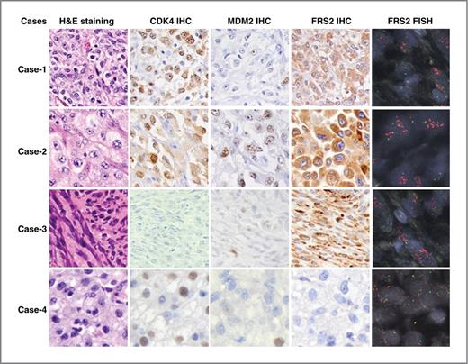 Figure 5. IHC staining of CDK4, MDM2, and FRS2 proteins in high-grade liposarcoma tissues. H&E staining (×200) shows the morphologic characters of 4 cases of high-grade liposarcomas. IHC staining of CDK4, MDM2, and FRS2 protein showed variable expression patterns in these high-grade liposarcoma tissues. Dual-color FISH assay validated amplification of FRS2 gene in 3 cases, and IHC analysis showed that FRS2 stain was positive in these tissues.