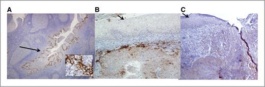 Figure 1. The reticulated epithelium of benign tonsil tissue expresses high levels of PD-L1. A, chronically inflamed tonsil tissue shows localized PD-L1 expression within the reticulated epithelium of tonsillar crypts (long arrow). Magnification, ×40. The inset (magnification, × 400) shows cell surface staining of the crypt epithelial cells. In contrast, the surface epithelium of the tonsils was negative for PD-L1 expression (short arrows; B and C). Magnification, ×40.