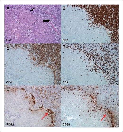 Figure 4. Colocalization of TILs with PD-L1 expression in HPV-HNSCC. A, hematoxylin and eosin stain of HPV-HNSCC (thin arrow marks tumor nests and thick arrow marks inflammatory stroma). Serial sections evaluated for: CD3 (B); CD4 (C); CD8 (D); PD-L1 (E); and CD68 expression (F). Red arrows indicate a representative area with clusters of PD-L1 and CD68 expression in serial sections (E and F). Magnification, ×400.