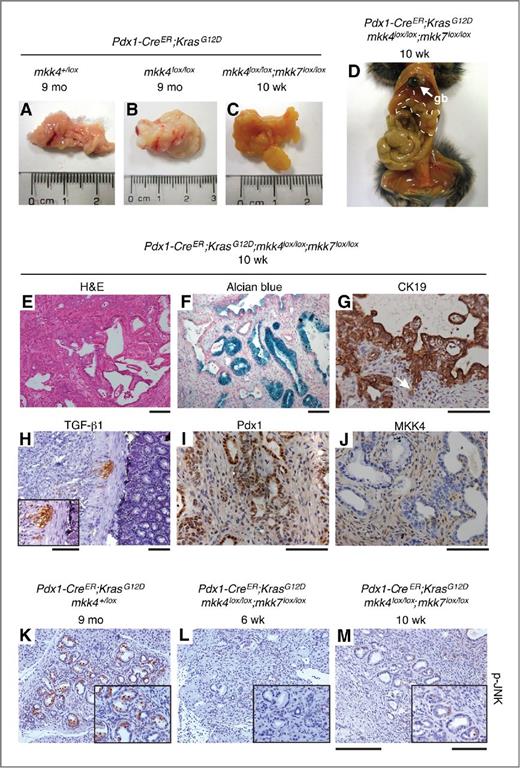 Figure 3. MKK4/MKK7-deficient mice expressing KrasG12D develop PDAC with high penetrance and short latency. A–C, representative images of whole pancreata from 9 months old and 10 weeks old control and experimental animals exposed to tamoxifen. D, photograph of a pancreatic adenocarcinoma obstructing the common bile duct and causing dilatation of the gall bladder (gb) and jaundice in the abdominal skin. Dashed line, pancreas. E, hematoxylin and eosin (H&E) staining show well-differentiated ductal adenocarcinoma with abundant stoma in KrasG12D expressing mkk4/mkk7 deleted mice at 10 weeks of age. All mice of this genotype (6/6) rapidly developed PDAC within 10 weeks of age (see also Fig. 2G and H for quantification of PanIN lesions). F–M, immunohistochemical analyses confirm the mucin producing (Alcian Blue, F) and ductal phenotype (CK19, G) of the tumors. The arrow indicates nascent invasion of CK19 expressing tumor cells into the stroma. Inset (H) shows TGFβ1-positive tumor cells migrating toward the gut. In addition, neoplastic ductal structures reexpress the progenitor marker Pdx1 (I), but lack MKK4 (J), whereas MKK4 is detected within the stroma compartment (J). p-JNK was readily detectable in spontaneously formed mPanINs in 9 months old KrasG12D expressing mice (K), but was absent in lesions displayed by 6 and 10 weeks old KrasG12D expressing mkk4/mkk7 deleted animals (L and M). Scale bars, 200 or 100 μm for inset in H.