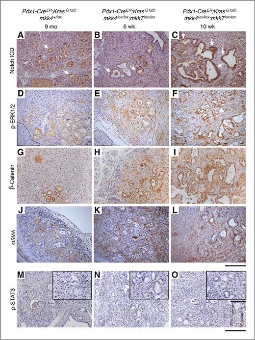 Figure 4. Notch, ERK1/2, β-catenin, and STAT3 signaling pathways are upregulated in pancreatic adenocarcinoma. Immunohistochemical analyses demonstrate that nuclear Notch ICD (arrows) in mPanIN lesions (A and B) is substantially upregulated in adenocarcinoma (C). The level of p-ERK1/2 is low in normal acinar parenchyma (highlighted areas in D and E), but elevated in mPanIN lesions and highly increased in adenocarcinoma (F). β-Catenin progressively accumulates through the transition from mPanIN to PDAC formation (G–I). Tumors are surrounded by abundant stroma (J–L). STAT3 phosphorylation is detected in epithelial cells of spontaneously formed mPanINs and in surrounding stromal cells (M–O). Scale bars, 200 or 100 μm for insets in M–O.