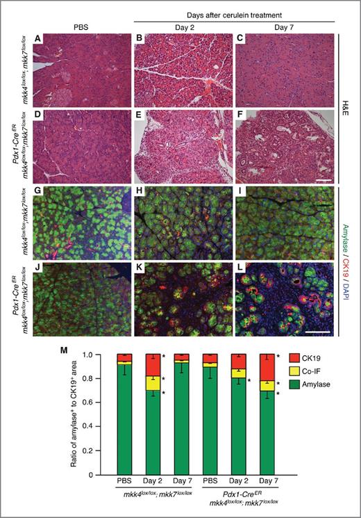 Figure 6. JNK signaling controls acinar cell reprogramming after induction of acute pancreatitis. Gene deletion was induced at day 7 through tamoxifen administered by oral gavage of lactating dams. At 5 weeks of age, mice were exposed to cerulein and sacrificed 2 or 7 days later. PBS-treated control animals were sacrificed 7 days after the last set of injections. A–F, hematoxylin and eosin (H&E) staining of pancreata from control (mkk4lox/lox;mkk7lox/lox) and mkk4/mkk7 deleted (Pdx1-CreER;mkk4lox/lox;mkk7lox/lox) mice. The deletion of mkk4/mkk7 suppresses acinar regeneration (compare C and F). G–L, immunofluorescence staining for amylase positive acinar cells (green) and ductal expressing CK19 cells (red). Both cohorts display sign of acute pancreatitis 2 days after exposure to cerulein as evident by the replacement of normal amylase positive exocrine parenchyma (G and J) with ductal structures coexpressing amylase and CK19 (H and K). By 7 days after treatment, amylase and CK19 expression in control pancreata was redistributed in a fashion similar to that seen with PBS-treated animals (compare G and I). In contrast, compound mutant mice display predominantly amylase and CK19 positive ductal structures with rare normal amylase positive acini (L). Scale bars, 100 μm. M, ratio of amylase, CK19, and amylase-CK19 co-immunofluorescence (co-IF) for each of the representative genotypes. N ≥ 3. Error bars, SEM. *, P < 0.05, significant difference between mice treated or not with cerulein.