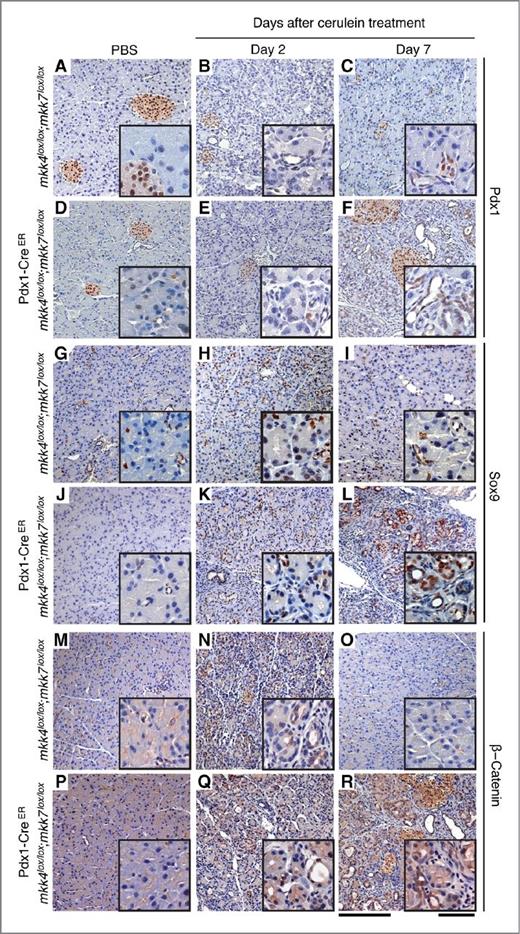 Figure 7. The loss of mkk4 and mkk7 locks damaged exocrine cells in a permanently de-differentiated state. Immunohistochemistry with antibodies directed against Pdx1 (A–F), Sox9 (G–L), and β-catenin (M–R) in pancreatic tissues obtained from mice exposed to tamoxifen at 7 days and treated with cerulein at 5 months. Cerulein exposure causes a transient upregulation of Pdx1, Sox9, and β-catenin in control animals (mkk4lox/lox;mkk7lox/lox). In contrast, 7 days after cerulein administration, duct-like structures expressing Pdx1, Sox9, and β-catenin persist in pancreata derived from Pdx1-CreER;mkk4lox/lox;mkk7lox/lox mice. Scale bars, 200 μm (low magnification) or 50 μm (insets).