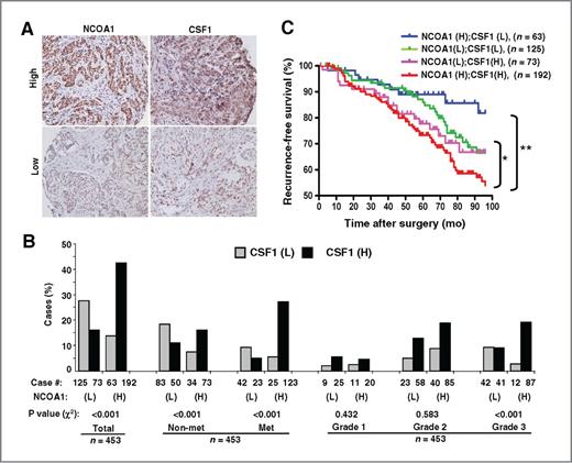 Figure 7. The expression of NCOA1 and CSF1 proteins in human breast tumors and their association with lymph node metastasis, tumor grade, and recurrence-free survival. A, representative images for high and low IHC signals of NCOA1 and CSF1 in human breast tumors. The original images were taken at ×100. B, the case numbers and percentages of NCOA1(L);CSF1(L), NCOA1(L);CSF1(H), NCOA1(H);CSF1(L), and NCOA1(H);CSF1(H) breast tumors in the total cohort and subgroups divided by negative (Non-met) and positive (Met) lymph node metastases and tumor grades. C, Kaplan–Meier recurrence-free survival curves for patient groups as indicated. H, high-expression group (3< IHC scores ≤8); L, low-expression group (0≤ IHC scores ≤3); n, number of patients; *, P < 0.05; **, P < 0.01 by the log-rank test.