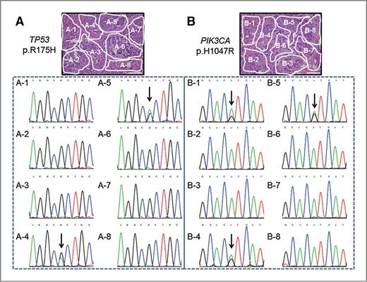 Figure 3. Multiple foci microdissection and analysis of intratumoral heterogeneity of TP53 and PIK3CA somatic mutations in the third cohort (n = 81). The arrows indicate somatic mutations. A, representative images of tissue with TP53 mutation heterogeneity (p.R175H). B, representative images of tissue with PIK3CA mutation heterogeneity (p.H1047R). Scale bar, 50 μm.