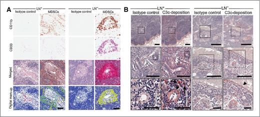 Figure 6. MDSC infiltration and C3 deposition and expression in lymph nodes of patients with breast cancer. A, immunohistochemistry detection of human MDSC markers CD11b (brown) and CD33 (fast red) in axillary lymph nodes with (LN+) or without (LN−) breast cancer metastases. Yellow in digital mark-up images indicates cells that coexpress both CD11b and CD33. B, immunohistochemistry detection of C3/C3c in LN+ and LN−. Boxes outline areas that are shown in higher magnification in panels below. Arrowheads, vessels with C3 cleavage product deposition; arrows, macrophages producing C3. Scale bars, 200 μm for A and 400, 200, and 50 μm for B (top, middle, and bottom, respectively). Data are representative of 12 patients diagnosed with breast NOS ductal carcinoma with axillary lymph node metastases (6 patients) and without axillary lymph node involvement (6 patients; A and B).