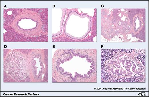 Figure 1. A normal pancreatic duct (A) and multiple (PanIN) lesions from the pancreas of a single patient with a family history of pancreatic cancer (B–F). These include PanIN-1 (B), PanIN with associated lobulocentric atrophy (B and C), PanIN-2 (E), and PanIN-3 (F; all hematoxylin and eosin). KRAS mutations and telomere shortening occur early in PanIN-1 lesions, p16/CDKN2A loss occurs slightly later in PanIN-2, and SMAD4 and TP53 inactivation are late events (PanIN-3 and invasive carcinoma).