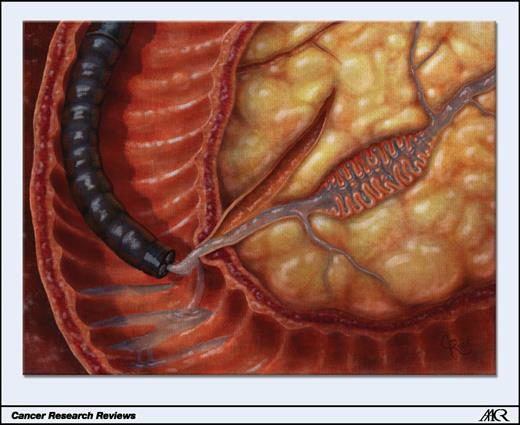 Figure 2. Genetic changes shed by precursor lesions involving the pancreatic duct system can be detected in pancreatic secretions collected at the time of endoscopy. Illustration by Christian Rose, copyright Johns Hopkins University.