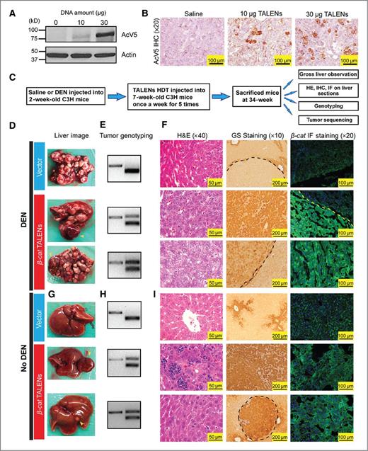 Figure 3. TALEN-mediated somatic mutagenesis in murine livers can drive tumor development. A, protein expression of β-catenin TALENs in liver 8 hours after HDT. C3H mice were HDT administrated with saline, 10 or 30 μg of each TALEN. B, IHC for AcV5 showing liver β-catenin TALEN expression after HDT injection. C, schema for using β-catenin TALENs to induce mutations in C3H mice. D, gross liver images of the C3H mice treated with GoldyTALEN vector (20 μg) or β-catenin TALENs (10 μg of each) plus DEN according to the schema in C. Yellow arrows, red, fleshy tumors, which were only found in β-catenin TALEN-treated mice. E, tumor genotyping of the above mice. For β-catenin TALEN-injected mice, the red, fleshy tumors were genotyped (if these tumors were identified). F, H&E staining (×40), GS IHC staining (×10), and β-catenin immunofluorescent (IF) staining (×20) of the tumors and livers from the above mice. For β-catenin TALEN-injected mice, the red, fleshy tumors were genotyped (if these tumors were identified). G, gross liver images of the C3H mice treated with GoldyTALEN vector (20 μg) or β-catenin TALEN (10 μg of each) without DEN. The red, fleshy tumor is indicated by the yellow arrow. H, tumor genotyping of the above mice. I, H&E staining (×40), GS IHC staining (×10), and β-catenin immunofluorescent staining (×20) of the tumors and livers from the above mice.