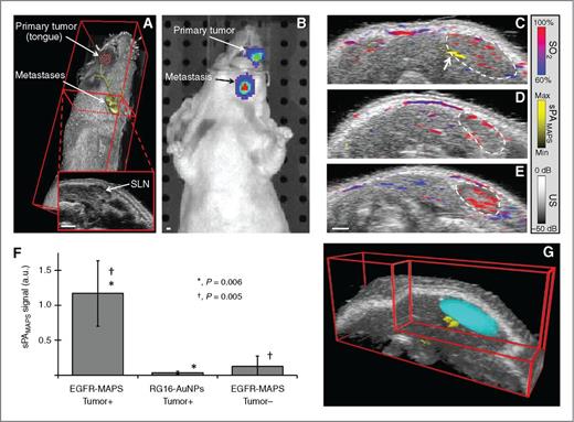 Figure 3. In vivo imaging of LN micrometastases. A, 3D ultrasound image of a mouse with an overlaid cartoon of the primary tumor in the tongue and micrometastases in the cervical lymph nodes. Inset, a 2D cross-section of the ultrasound image with a LN seen as the dark, hypoechoic bean-shaped region. B, a representative bioluminescence image confirms the presence of FaDu cells in the primary tumor and in the lymphatic system. Representative overlaid ultrasound (US) and sPA images of a tumor-bearing mouse with a LN metastasis 2 hours after a peritumoral injection of either EGFR-targeted MAPS (C) or control RG16-conjugated AuNPs (D) and a normal mouse (E) 2 hours after a submucosal injection of EGFR-targeted MAPS. Hemoglobin (sPAHb) is depicted in red–blue, as determined by the oxygen saturation, while the presence of cancer cells labeled with MAPS (sPAMAPS) is depicted in yellow (see an arrow pointing to a micrometastasis in C); the anatomic location of a cervical LN is outlined by a dashed white line. Note the strong sPAMAPS signal in tumor-bearing mice injected with EGFR-targeted MAPS. F, the LNs were split into three categories for analysis: (i) LNs containing metastases in mice injected with EGFR-targeted MAPS (N = 7), (ii) LNs in tumor-bearing mice injected with RG16-conjugated AuNPs (N = 7), and (iii) LNs without metastasis in mice with or without a primary tumor injected with EGFR-targeted MAPS (N = 8). The total signal of activated MAPS was used as indicator of metastases. The metastatic LNs in tumor-bearing mice exhibit a statistically significant increase in the sPAMAPS signal. The P values are from a Mann–Whitney U test and error bars correspond to one standard deviation. G, a 3D reconstruction of the ultrasound images with the SLN volume segmented from the 2D ultrasound images (cyan), with the overlaid 3D sPA image showing the volumetric distribution of the sPAMAPS signal. All scale bars, 1 mm.