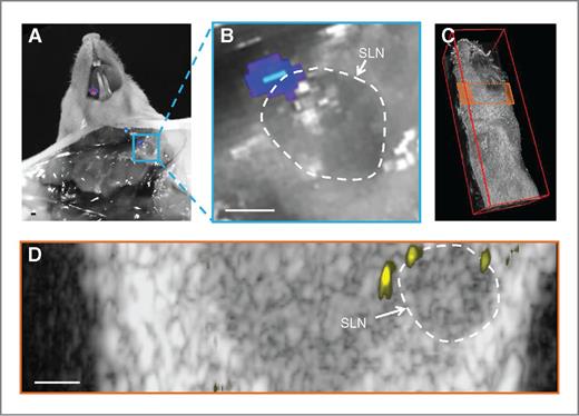 Figure 4. Spatial correlation between sPAMAPS signal and bioluminescence. A and B, photograph with overlaid bioluminescence image showing a small metastasis at the edge of the LN. C, ultrasound image showing the imaging plane depicted in D. E, an ultrasound image of the plane depicted in D and overlaid sPAMAPS signal shows two micrometastases that generated the bioluminescence signal and a third that was undetected by bioluminescence.