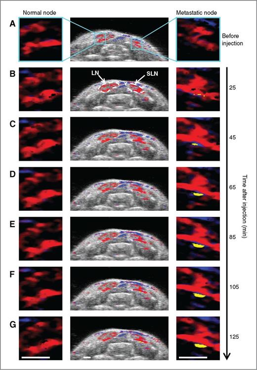 Figure 5. Kinetics of MAPS interaction with micrometastasis. Combined ultrasound and sPA image of a 2D cross-section containing two LNs (center), and 4× enlarged sPA images of a region on the border of the left LN (left) and right LN (right; A) before, 25 (B), 45 (C), 65 (D), 85 (E), 105 (F), and 125 (G) minutes after the injection of MAPS. The steadily growing region of activated MAPS in the right LN indicates that MAPS are gradually being delivered to and are interacting with cancer cells on the border of the LN. Scale bars, 1 mm.