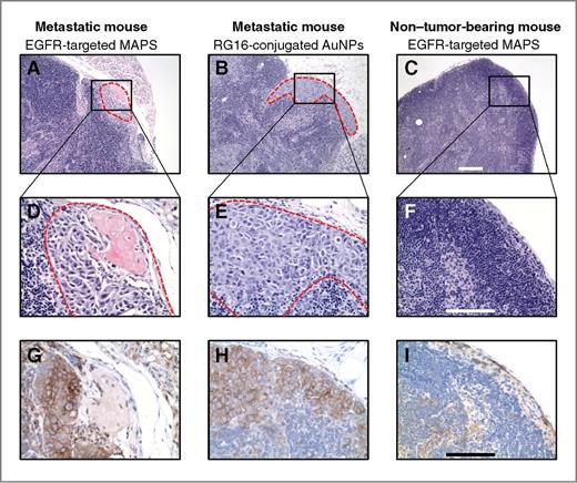 Figure 6. Histologic evaluation of excised LNs. A and B, H&E staining of LNs from mice with positive bioluminescent signal in LNs shows the subcapsular formation of micrometastases (dashed red outline) near an afferent lymph vessel. C, the morphology of a LN from a normal mouse is shown for reference. D and E, at high magnification, the irregular shape and large nuclei indicate presence of cancer cells in H&E sections. F, a normal population of lymphatic cells is seen in normal mice. Immunohistochemical staining shows elevated expression of EGFR in the micrometastases (G and H) and negligible EGFR expression in normal nodes (I). Scale bars, 200 μm (A–C) and 100 μm (D–I).