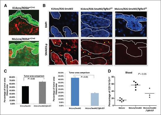 Figure 2. Genetic evidence for the role of TGF-β signaling during SmoM2-induced tumor development. A, expression of GFP and tomato red in K14cre/ROSAmT/mG and Mx1cre/ROSAmT/mG reporter mice. GFP expression indicates cre recombination. The epidermis was within the white line. As expected, GFP expression was only observed within the epidermis in K14cre/ROSAmT/mG mice, whereas the epidermis from Mx1cre/ROSAmT/mG mice (after polyI:C stimulation) had GFP in both epidermis and dermis. B, images with phosphorylated SMAD3 staining (Smad3-P) in skin tissues of different mice. As readout of TGF-β signaling, phosphorylated SMAD3 was detected both in epidermis/tumor and dermis in K14cre/R26-SmoM2 (left and positive staining in red, and tumors were circulated by white lines). In K14cre/R26-SmoM2/Tgfbr2f/f mice in which Tgfbr2 was knockout in keratinocytes, phosphorylated SMAD3 was only detected in the stroma (*, positive cells in red). In contrast, Mx1cre/R26-SmoM2/Tgfbr2f/f mice, which had Tgfbr2 knockout in both keratinocytes and stroma/dermis, had almost no detectable phosphorylated SMAD3. Epidermis and tumors are circled by white lines. C, the percentage of tumor area/tissue area from multiple mice (n > 3) in each group. P values below 0.05 were regarded as statistically significant between Tgfβr2-expressing and Tgfβr2-deficient mice. D, the blood and spleen levels of CD11b+Gr1+ cells from Mx1-cre mice. The levels of CD11b+Gr1+ cells from blood and spleen are associated with the severity of skin tumor phenotypes. Mx1-cre/SmoM2/Tgfβr2f/f mice had a significant decrease of CD11b+Gr1+ cell population in blood and spleen in comparison with Tgfbr2-expressing Mx1-cre/SmoM2 mice (P < 0.05).
