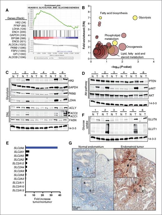 Figure 1. Glucose metabolism and DNL pathways are enriched in endometrial tumor tissue. A, enrichment plot of genes regulating glycolysis and gluconeogenesis in endometrial tumors compared with nontumor tissue. Glycolytic enzymes (ranked gene expression) are listed on the left. B, gene expression pathways enriched in the malignant endometrium compared with nontumor endometrium. Groups of genes regulating glycolysis, fatty acid biosynthesis, and lipid metabolism are depicted with yellow circles. Larger circle diameters indicate greater numbers of genes involved in pathway. C, D, and F, the expression of glycolytic/DNL enzymes, Akt signaling pathway proteins, and glucose transporters in tumor (T) and normal adjacent (N) endometrial tissue (six matched patient samples). 14-3-3 served as a loading control for all blots. E, fold increase in gene expression of GLUT transporter family members in endometrial tumor tissue compared with nontumor tissue. G, GLUT6 expression in tumor and normal endometrium. Endothelial (arrowheads), stromal (S), glandular epithelial (E), and luminal (L) cells of endometrium.