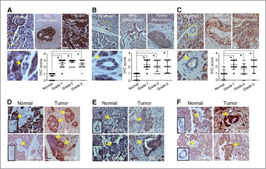 Figure 1. IHC staining of eIF5A1, eIF5A2, and hypusinated eIF5A1 (Hyp-eIF5A1) in human PDAC or normal pancreatic tissue sections. A–C, IHC staining of eIF5A1 (A), eIF5A2 (B), and Hyp-eIF5A1 (C) in normal human pancreatic tissues and PDAC tissues of varying tumor grades. A–C, graphs show quantitative analyses of blind scoring on a 0–3 scale. IHC staining of eIF5A1 (D), eIF5A2 (E), and Hyp-eIF5A1 (F) in matched normal and tumor tissues from PDAC patients BK-17 and BK-19. A–F, arrows indicate normal pancreatic ducts or tumor tissues and boxed regions show normal ducts with corresponding high magnification images. Bars, 100 μm. *, P < 0.05, as determined by the Student t test.