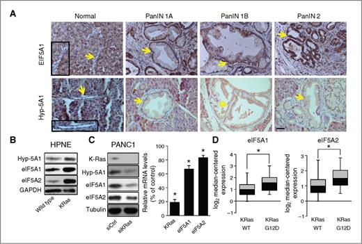 Figure 2. eIF5A protein levels and hypusination are upregulated in PanINs and PDAC cell lines in response to KRas activation. A, IHC staining of eIF5A1 and hypusinated eIF5A1 (Hyp-5A1) in PanINs of Pdx-Cre:LSL-KRASG12D mouse tissues. Arrows indicate normal pancreatic ducts or PanIN tissues and boxed regions show normal ducts with corresponding high magnification images. Bar, 100 μm. B, normal human pancreatic cells (HPNE) with or without exogenous KRasG12D expression were Western blotted for eIF5A1, eIF5A2, and Hyp-5A. C, PANC1 cells that harbor the KRasG12D mutation were depleted of KRas by siRNA-mediated knockdown (siKRas) and Western blotted for the indicated proteins. Right, mRNA levels of KRas, eIF5A1, and eIF5A2 in KRas-knockdown cells relative to control siRNA-transfected cells (siCtrl). D, Oncomine analyses of eIF5A1 and eIF5A2 mRNA levels in lung adenocarcinoma patient samples harboring wild-type KRas (WT) or the KRasG12D mutation (G12D), as derived from Okayama et al. (39). *, P < 0.05, as determined by the Student t test.