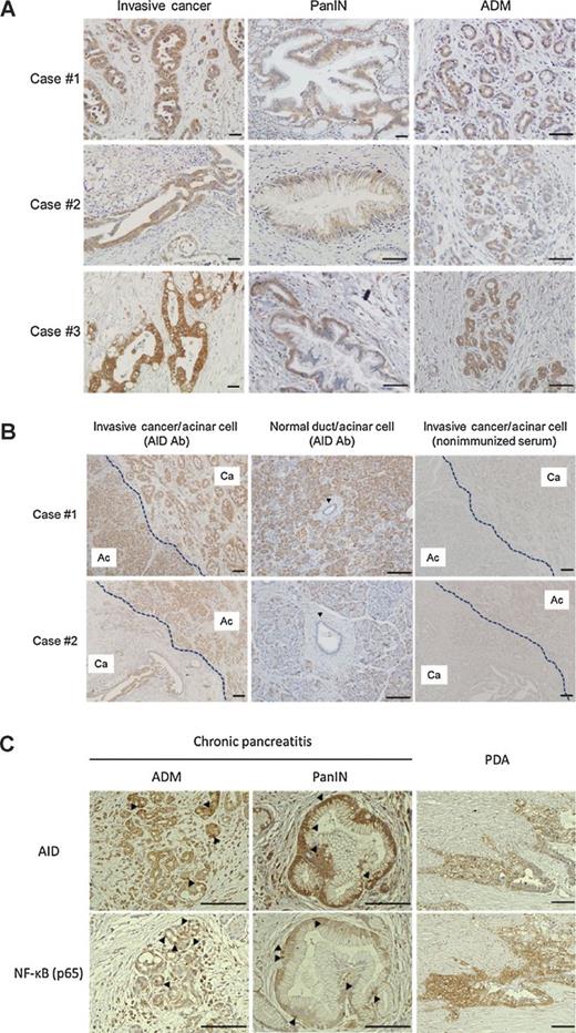 Figure 1. Representative images of immunohistochemistry for AID in ADM, PanIN, and PDAC (invasive cancer). A, the majority of the invasive cancers strongly expressed AID protein. On the other hand, human ADM and PanIN lesions only weakly expressed AID protein (scale bars, 50 μm). B, several PDAC specimens showed AID protein expression in acinar cells adjacent to invasive cancer (Ac, acinar cell; Ca, invasive cancer; left). On the other hand, normal ducts showed no AID protein expression (middle, arrowhead). Right, negative control with nonimmunized serum (scale bars, 100 μm). C, AID protein expression was detected in ADM and PanIN lesions in human chronic pancreatitis as well as PDAC tissues (top, arrowheads). Immunohistochemistry of serial sections confirmed that these AID protein expressions were accompanied by p65 nuclear translocation, suggesting NFκB activation (bottom, arrowheads; scale bars, 100 μm).